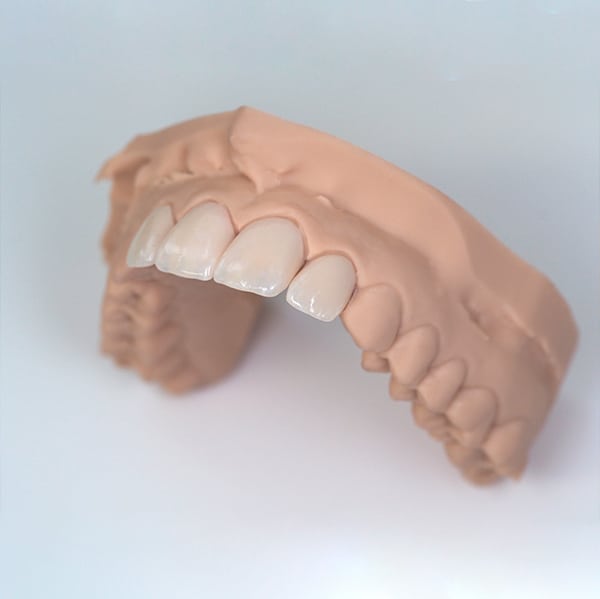 An example of veneers from Chomp Dental
