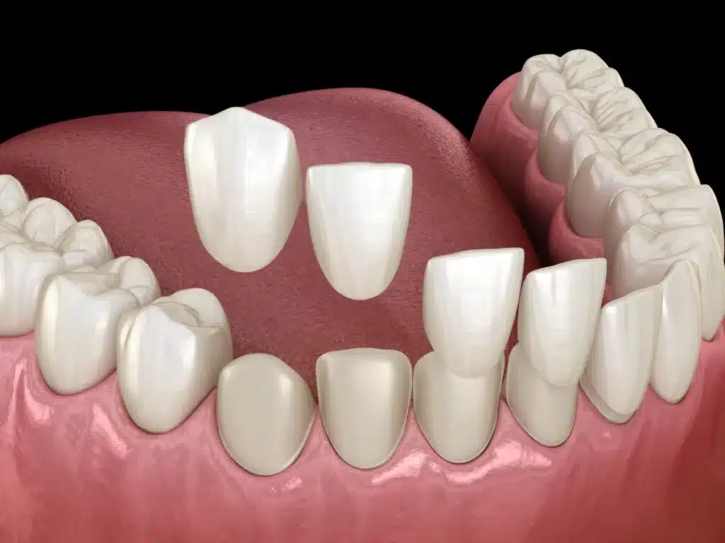 Composite Veneers