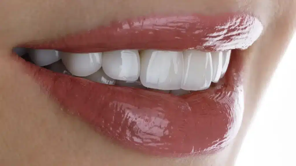 Porcelain Veneers