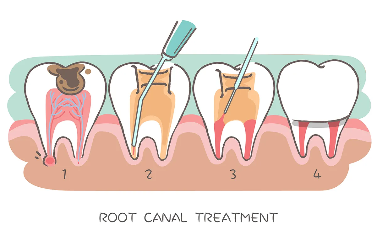 An example of the Root Canal Treatment process from Chomp Dental