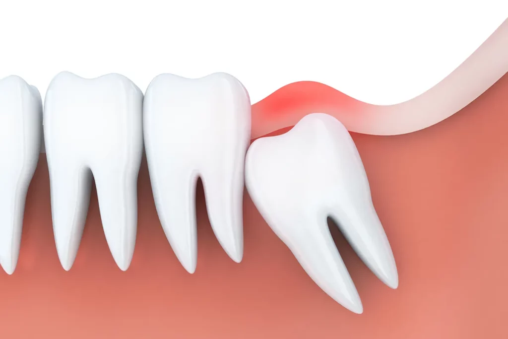 Impacted Wisdom Teeth