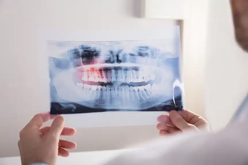The Chomp Dental dentist reviews the x-ray results in preparation for the wisdom tooth removal